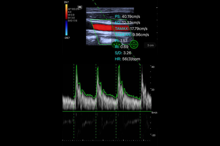 PW Mode:
Doppler pulsado para velocidade de fluxo. Medições precisas de velocidade.