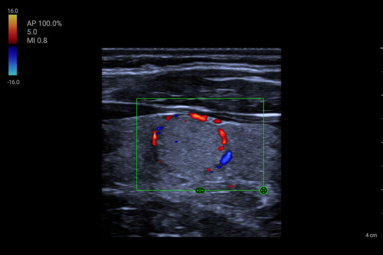 Color Mode:
Doppler colorido para fluxo sanguíneo. Detecção precisa de fluxo.
